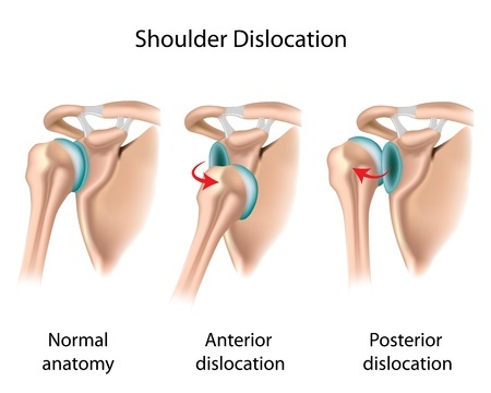 dislocated shoulder